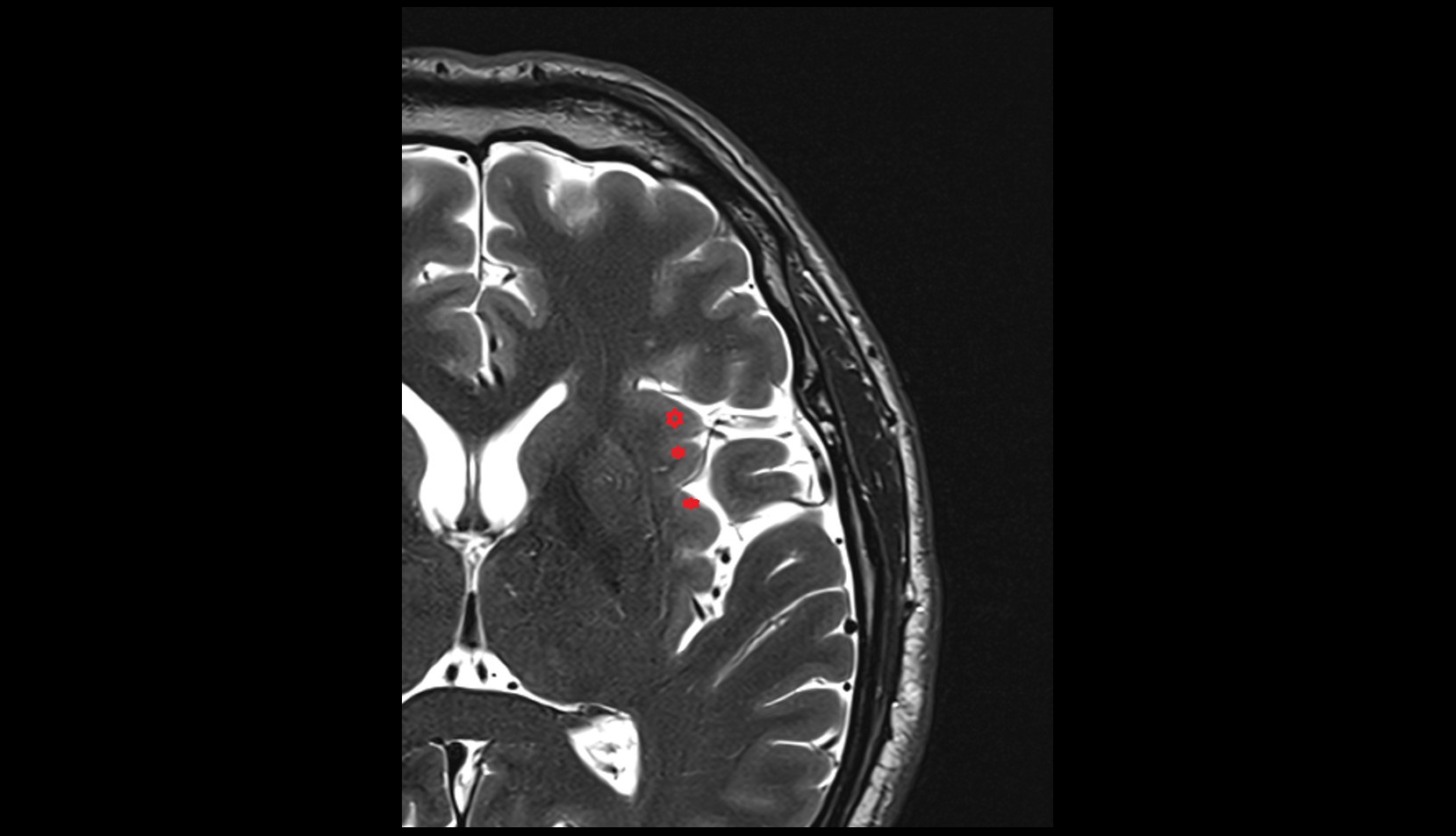 Short gyri of insula MRI 3T axial image
