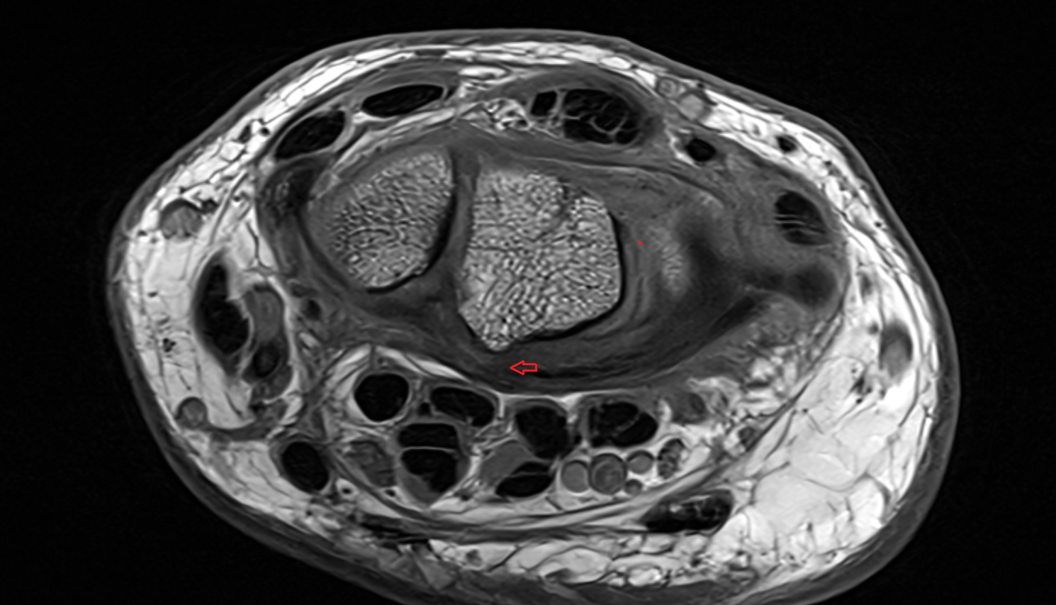 Short radiolunate ligament axial cross sectional anatomy 3T MRI AI enhanced radiology image-img-00000-00000
