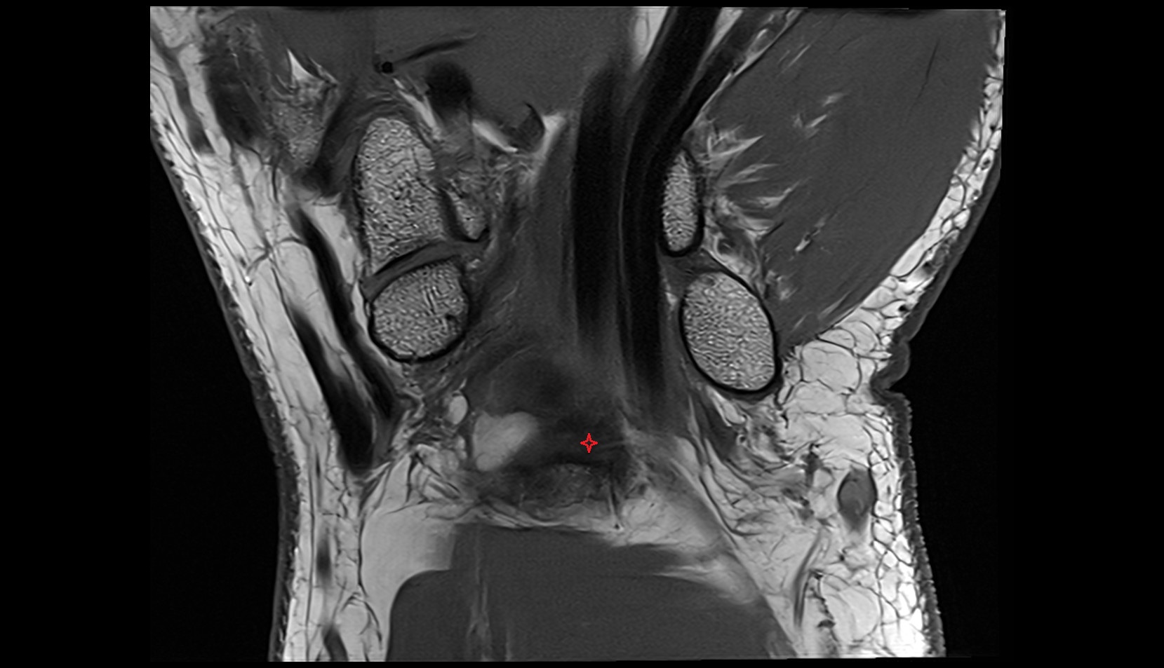 Short radiolunate ligament coronal mri image