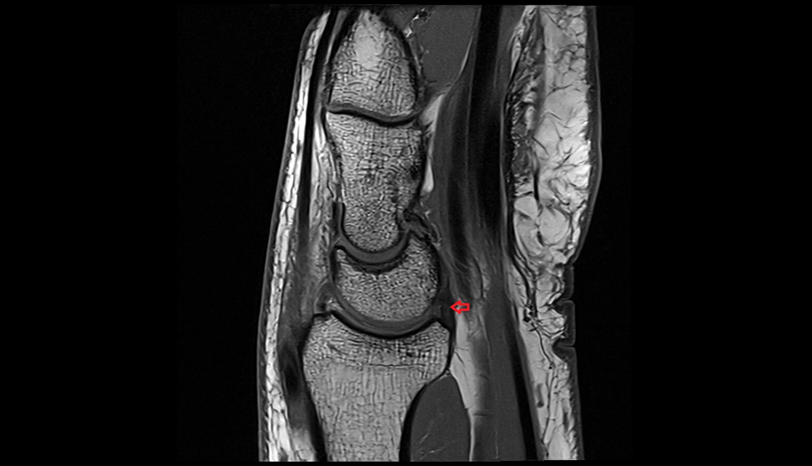 Short radiolunate ligament mri sagittal image