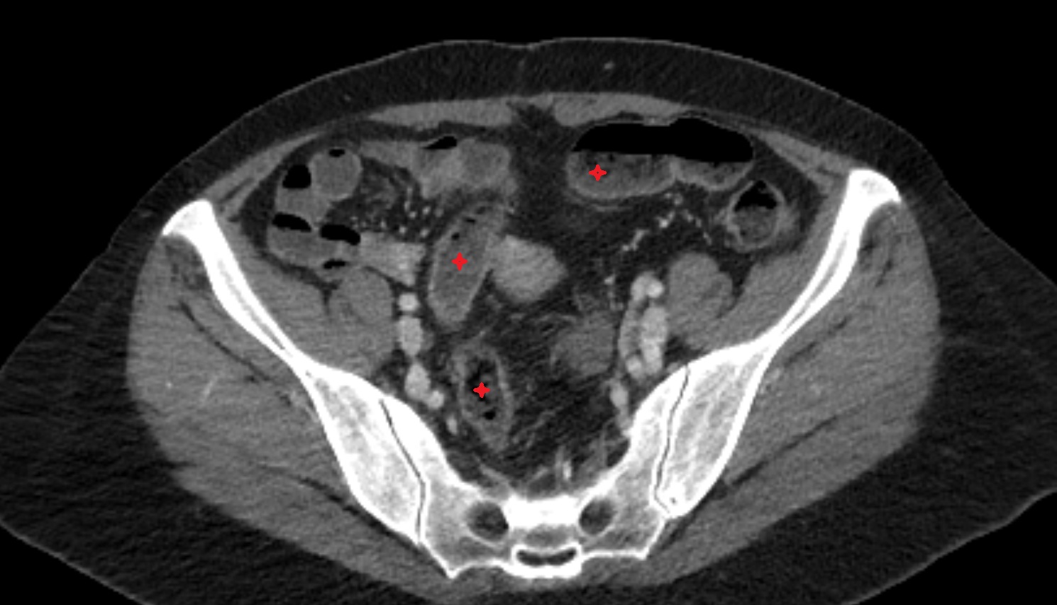 Sigmoid colon ct axial  anatomy  image-img-00000-00000