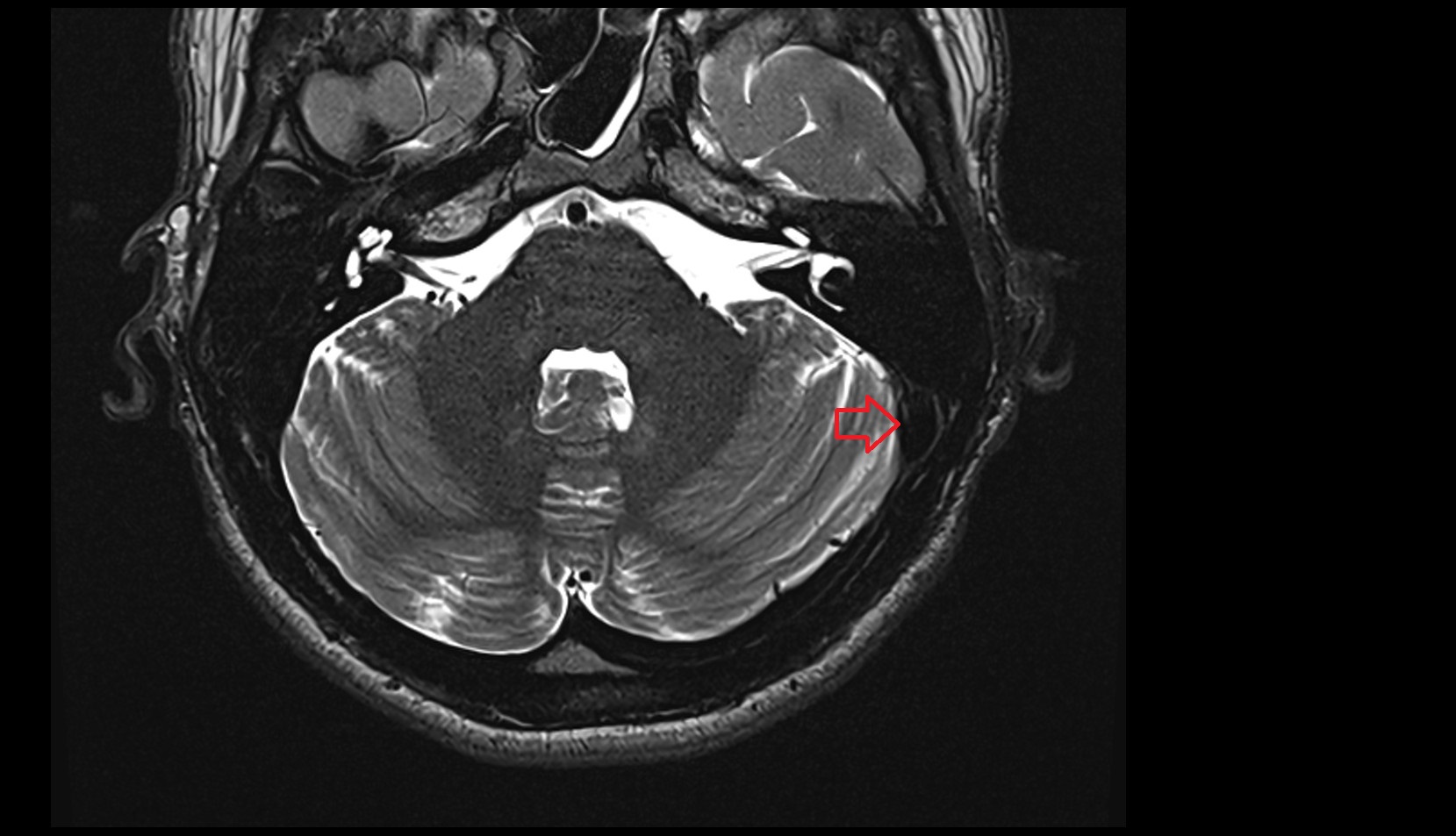 Sigmoid sinus MRI 3T axial image