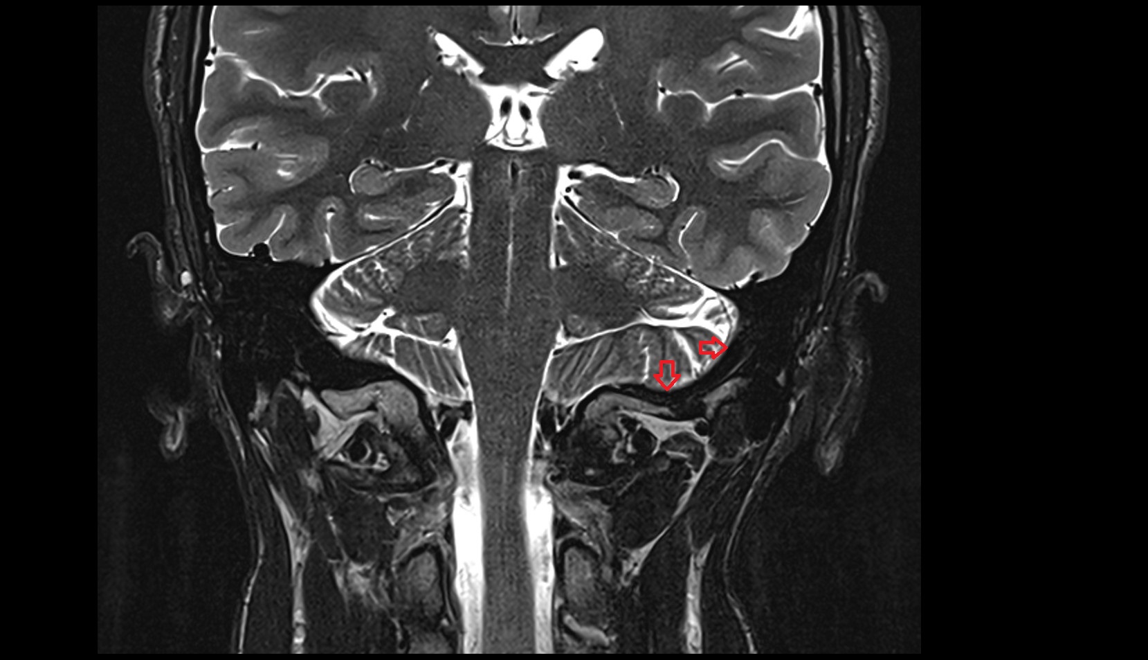 Sigmoid sinus MRI 3T coronal  image