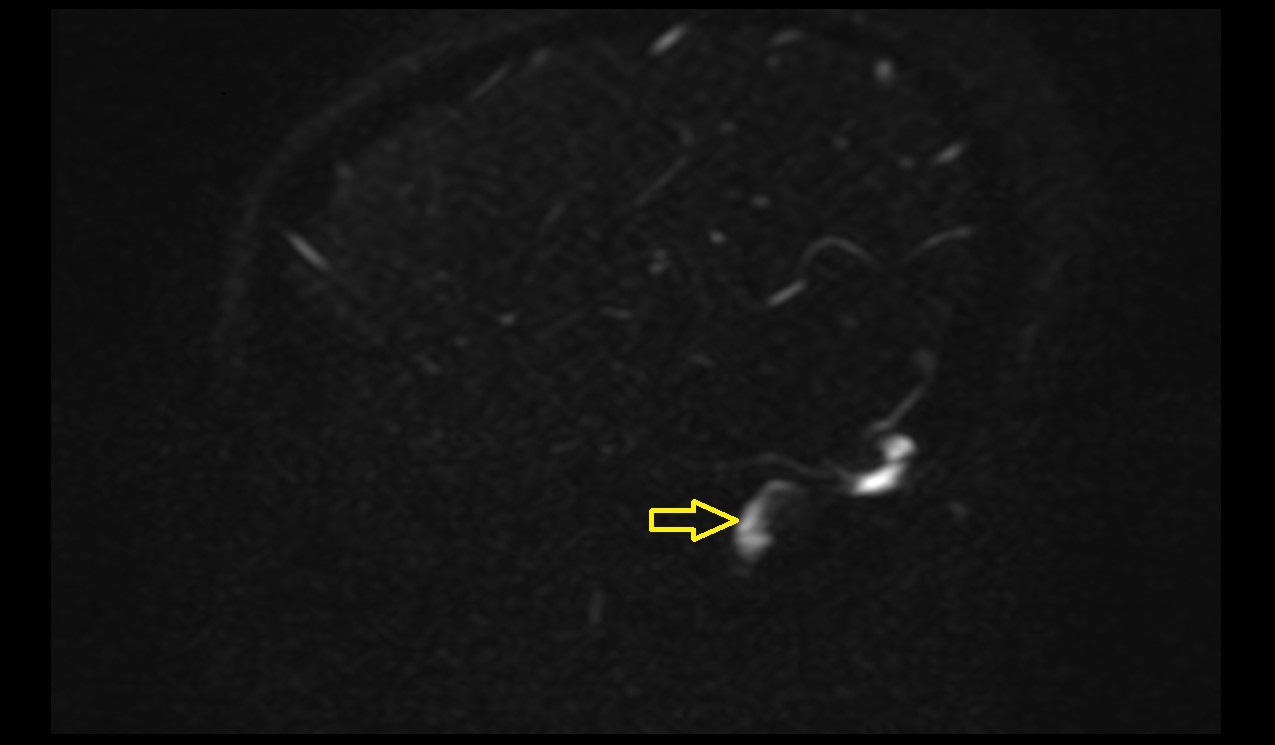 Sigmoid sinus MRI 3T sagittal pc image