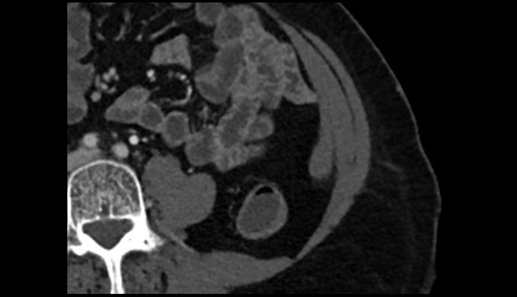 Sigmoid veins CT axial image 0