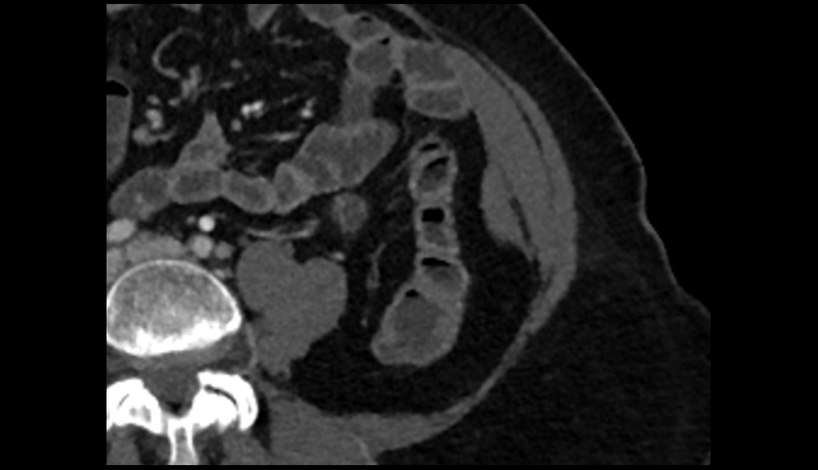 Sigmoid veins CT axial image 1