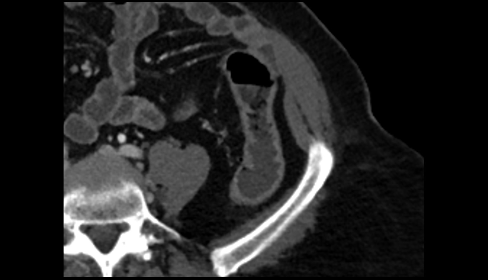 Sigmoid veins CT axial image 2