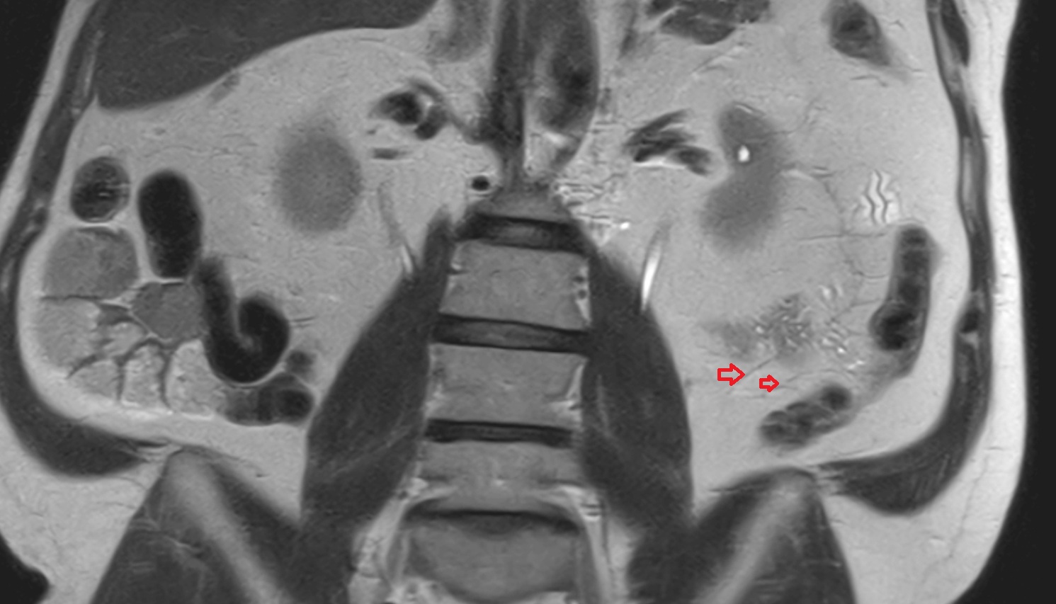 Sigmoid veins  MRI coronal  anatomy  image -img-00000-00000
