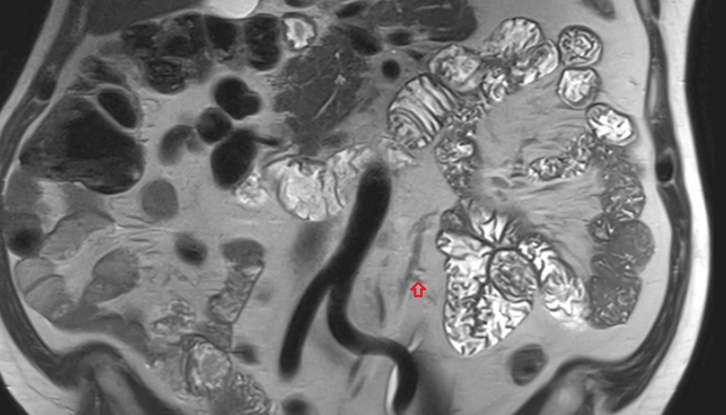 Sigmoid veins  MRI coronal  anatomy  image -img-00000-00000_00001