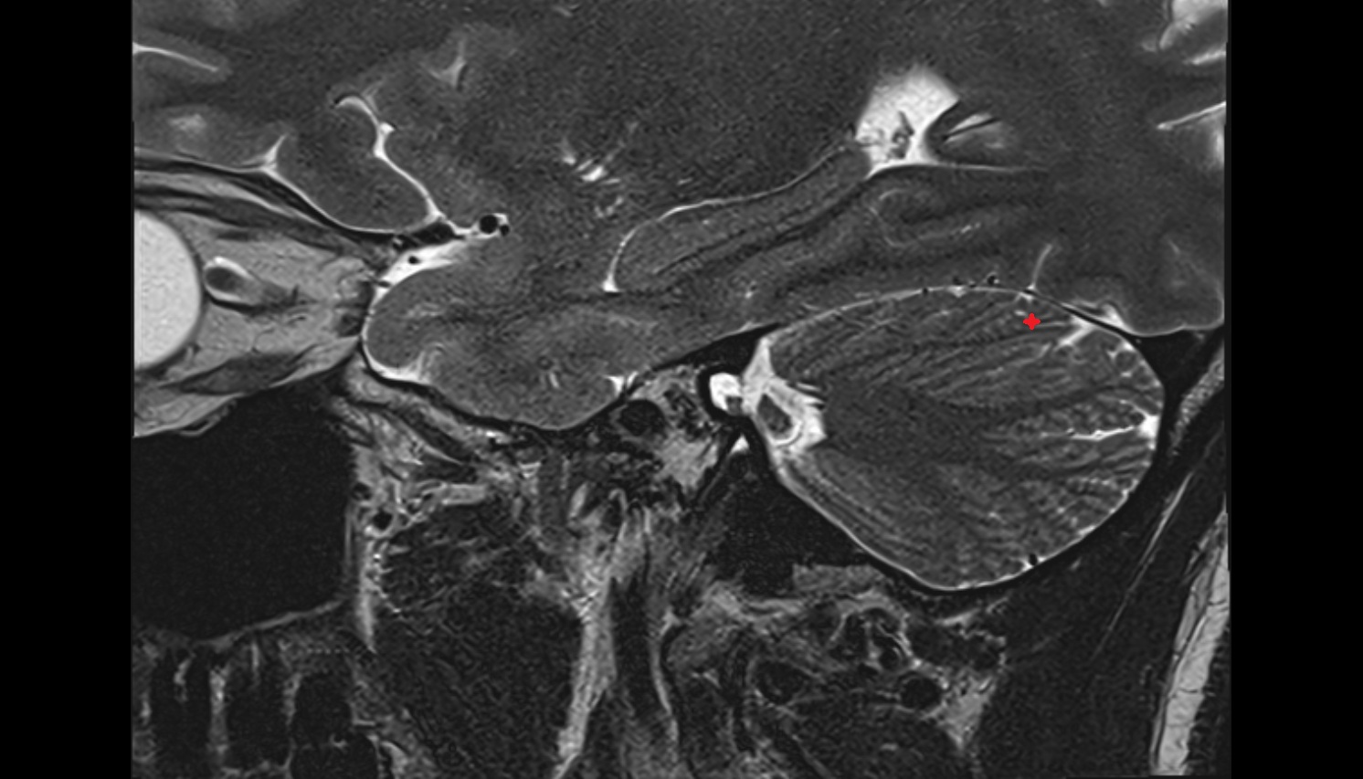 Simple lobule (HVI) of Cerebellum  mri sag  image -img-00000-00000