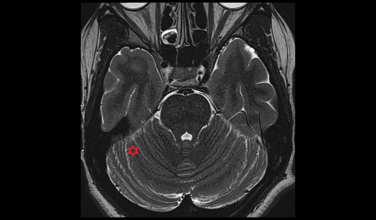 Simple lobule MRI 3T axial image