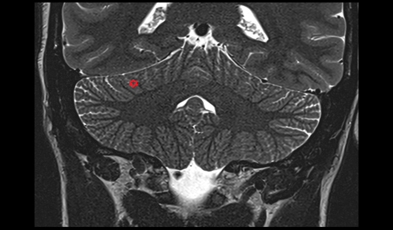 Simple lobule MRI 3T coronal image
