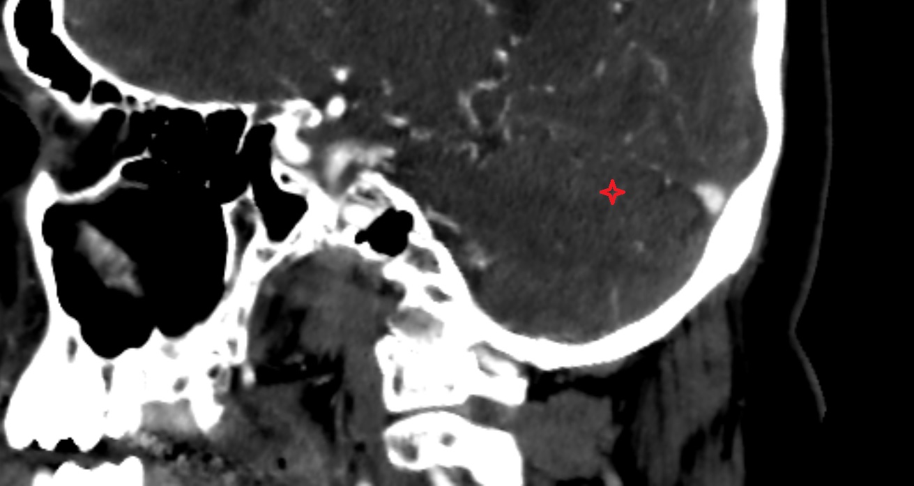 Simple lobule of cerebellum  CT sag  anatomy image -img-00001-00001