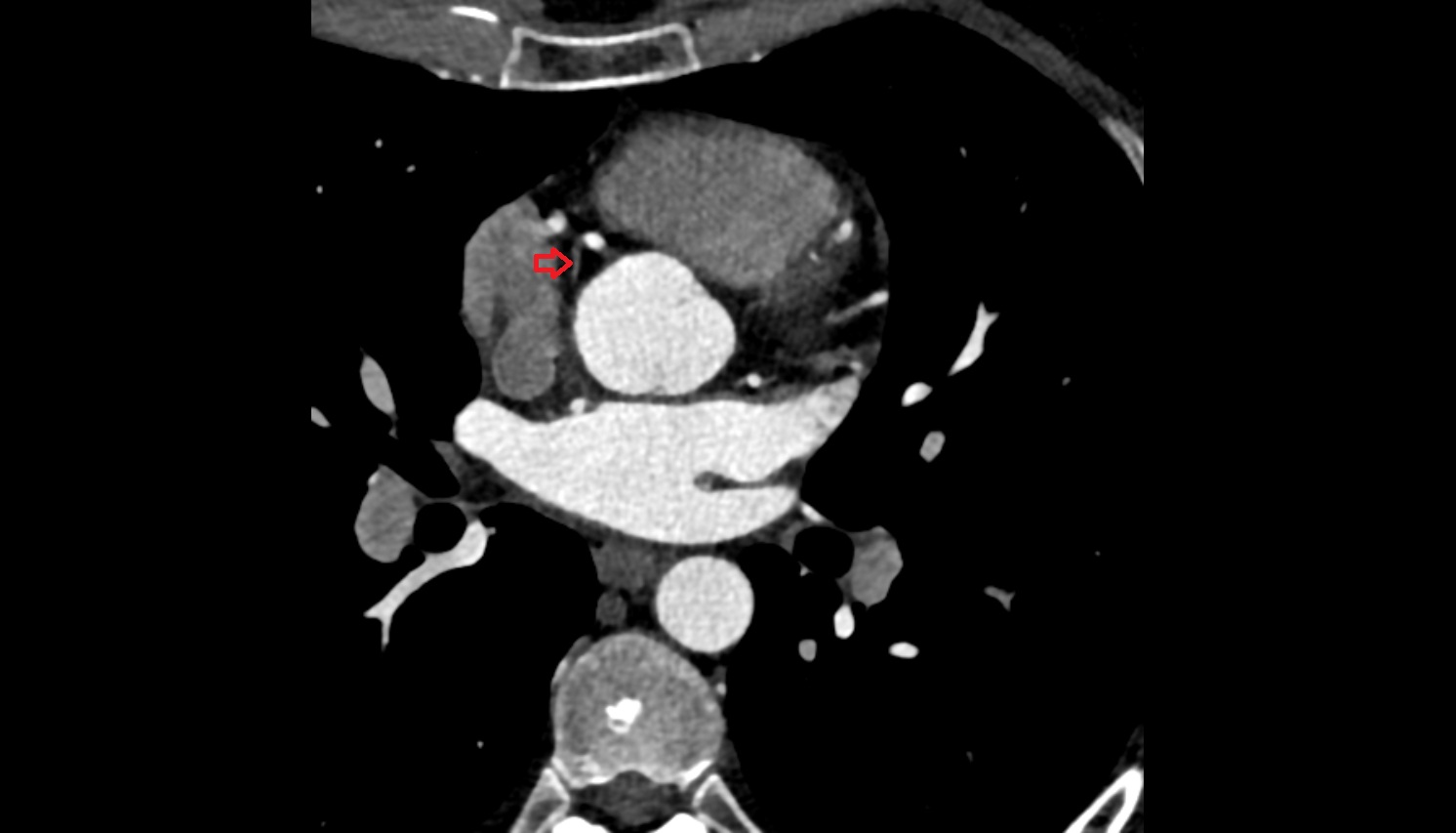 Sinoatrial nodal arter  anantomy  CT  axial image -img-00000-00000