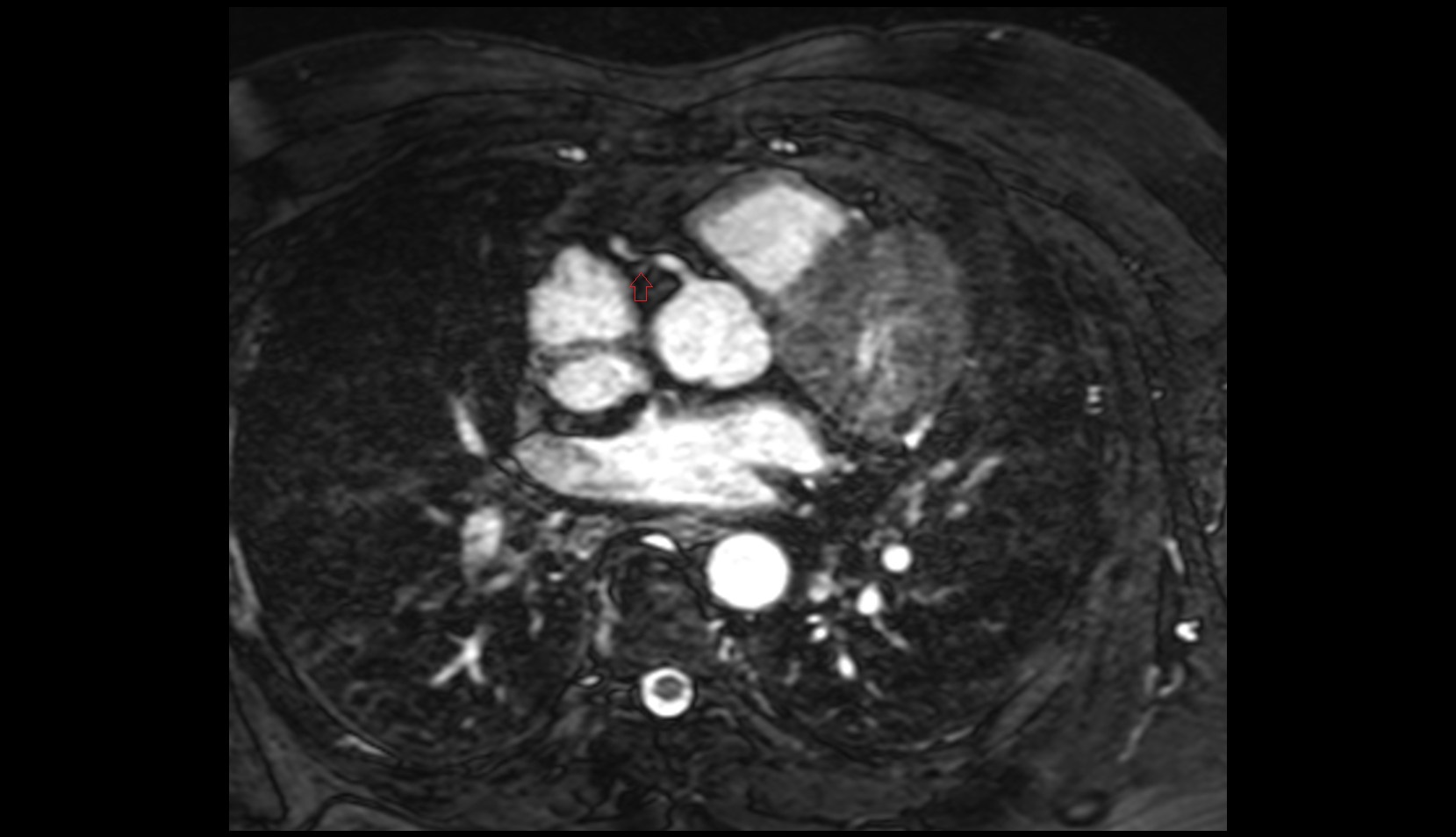 Sinoatrial nodal artery mri axial image
