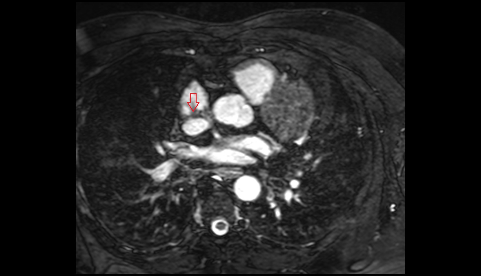 Sinoatrial node (SA node) MRI axial image