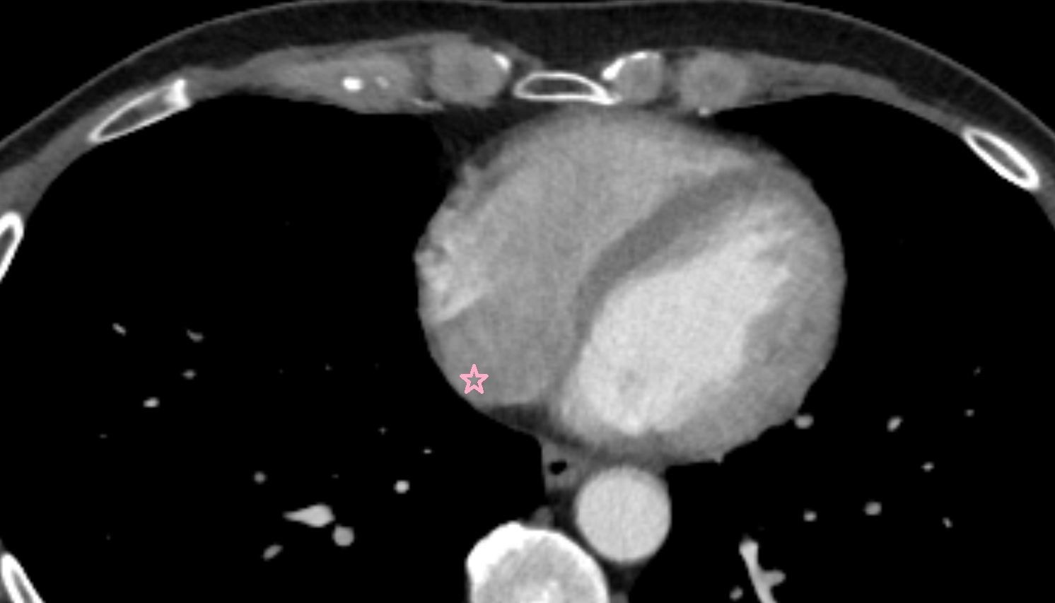 Sinus of venae cavae (sinus venarum)  anatomy CT AXIAL  image -img-00000-00000
