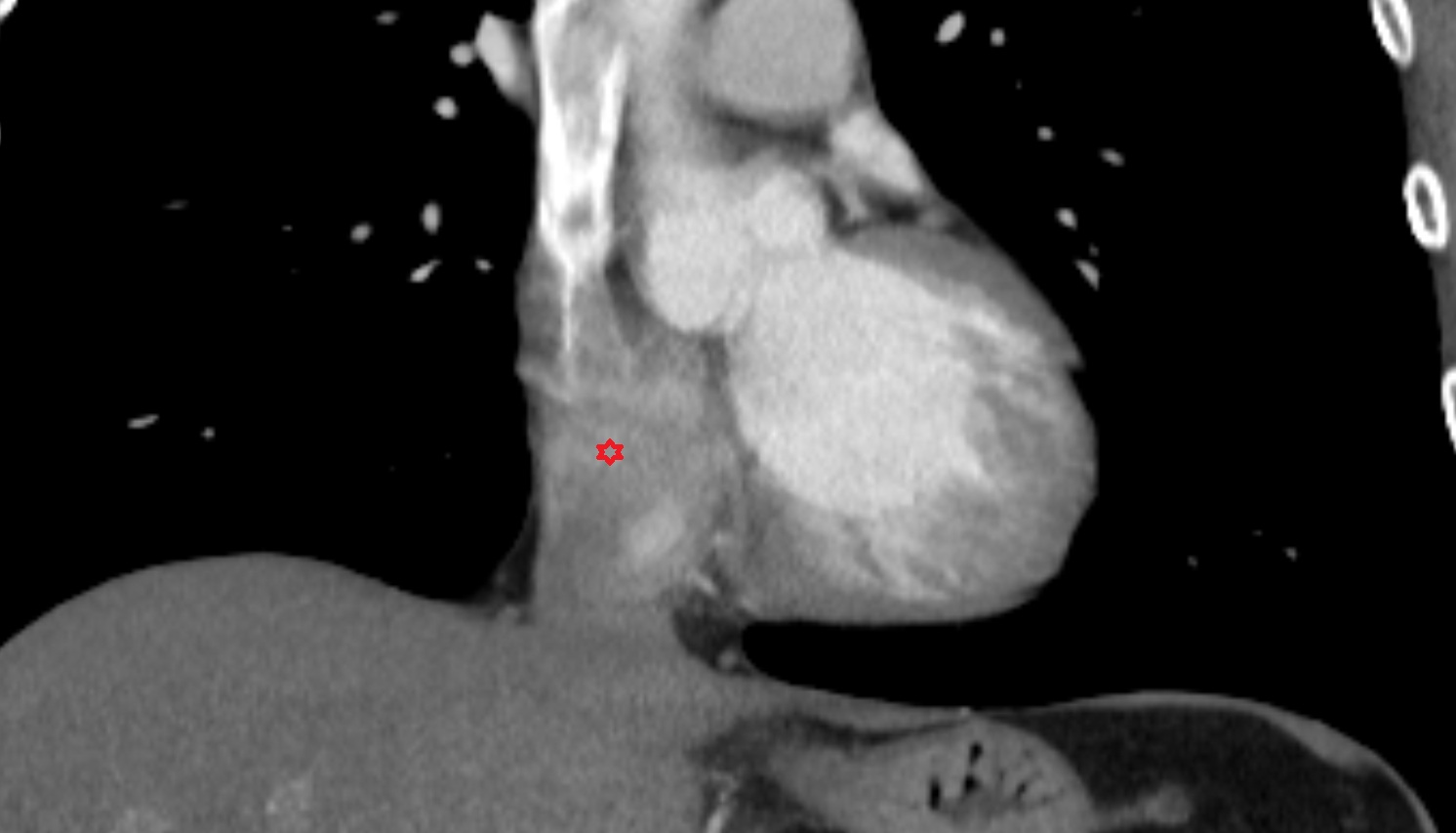 Sinus of venae cavae (sinus venarum)  anatomy CT CORONAL image -img-00000-00000