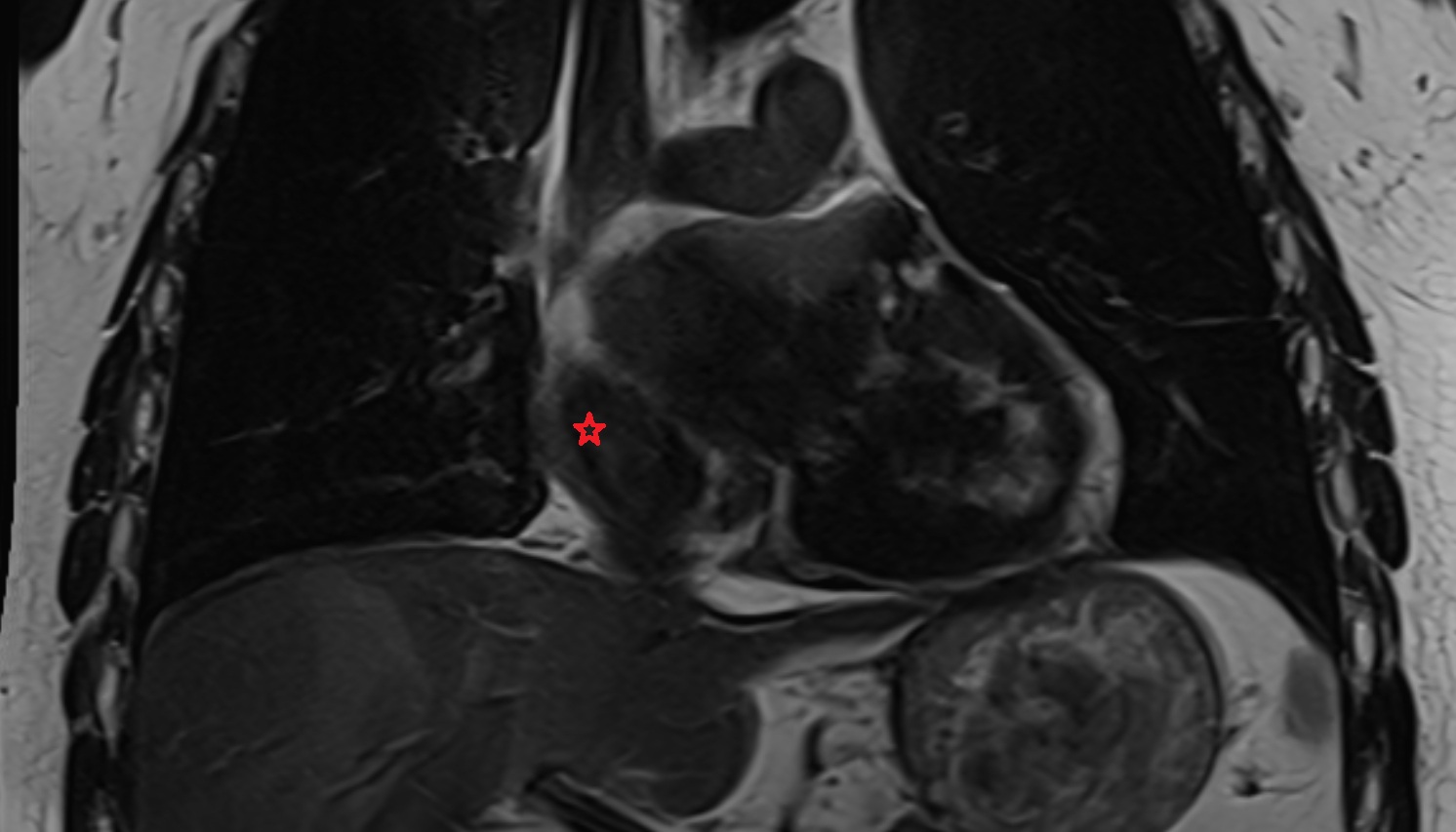 Sinus of venae cavae (sinus venarum)  anatomy MRI CORONAL image -img-00000-00000
