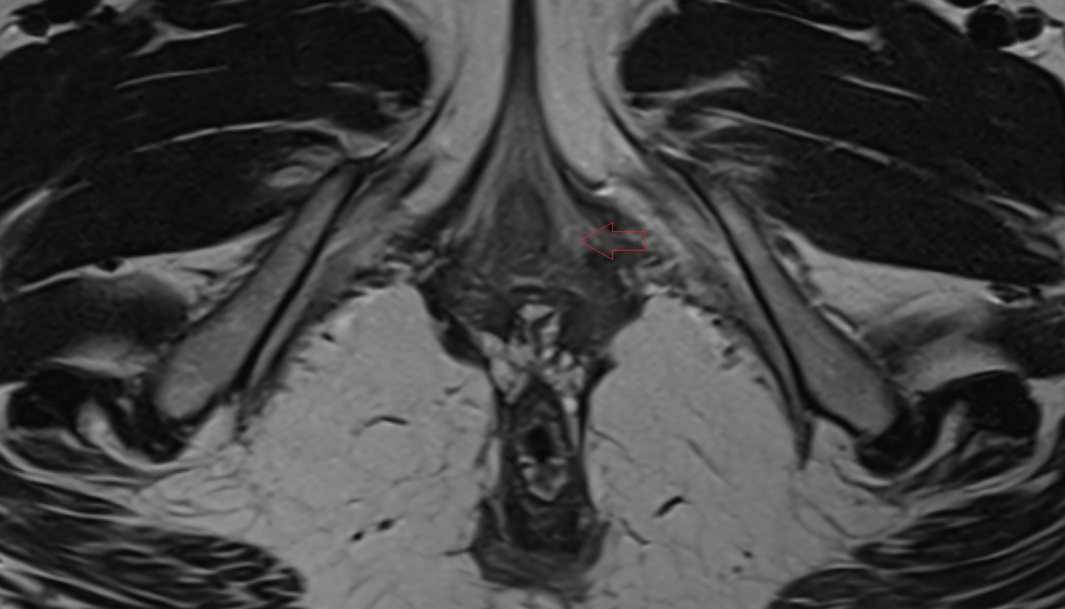 Skene’s gland MRI axial anatomy  image-img-00000-00000