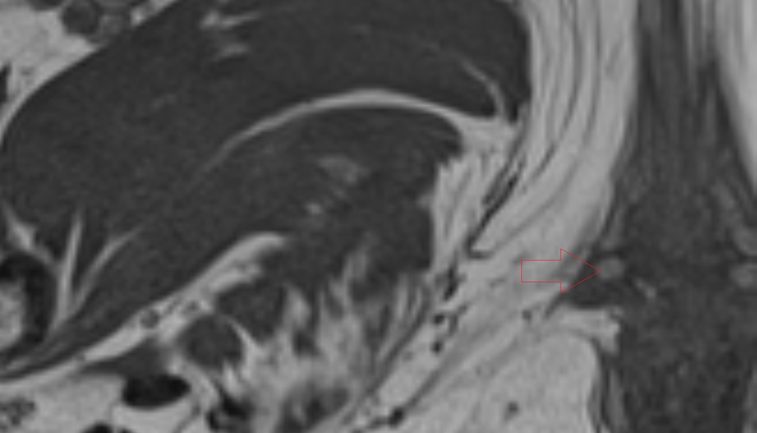 Skene’s gland MRI axial anatomy  image-img-00000-00000_00001