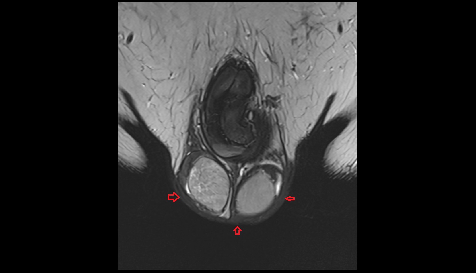 Skin of scrotum coronal mri