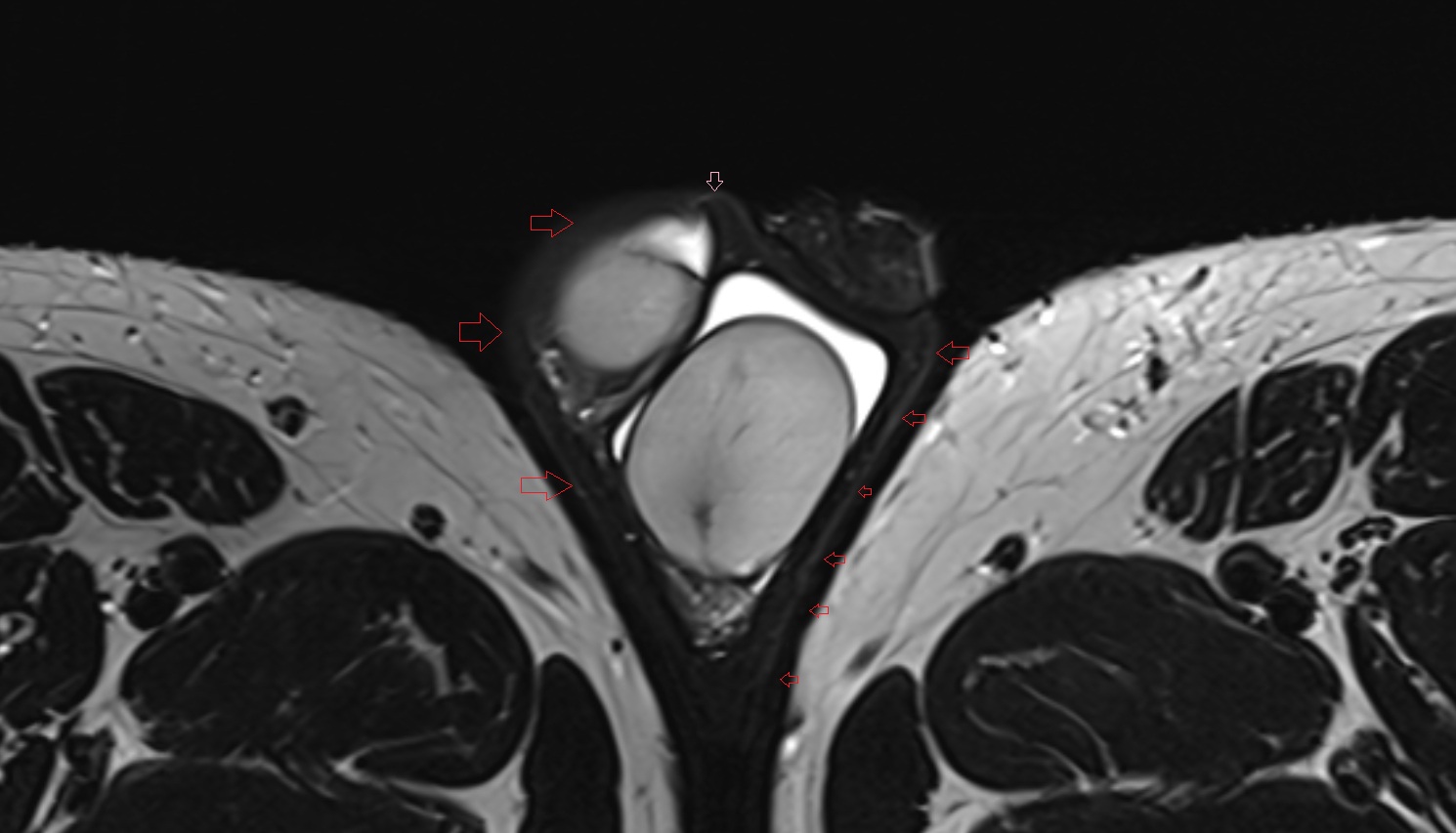 Skin of scrotum  mri axial  anatomy  image-img-00000-00000