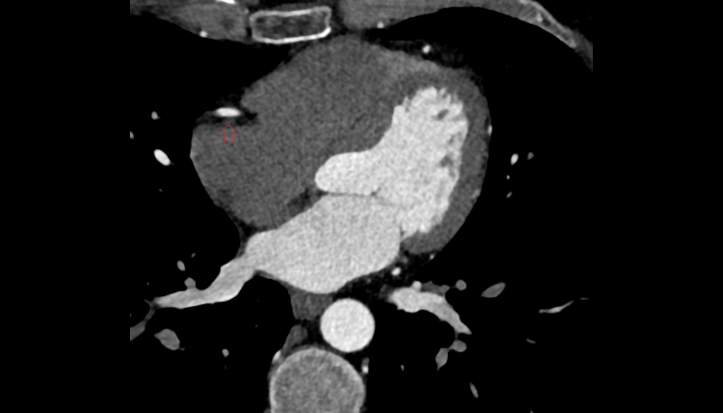 Small cardiac vein anatomy  CT  axial image -img-00000-00000
