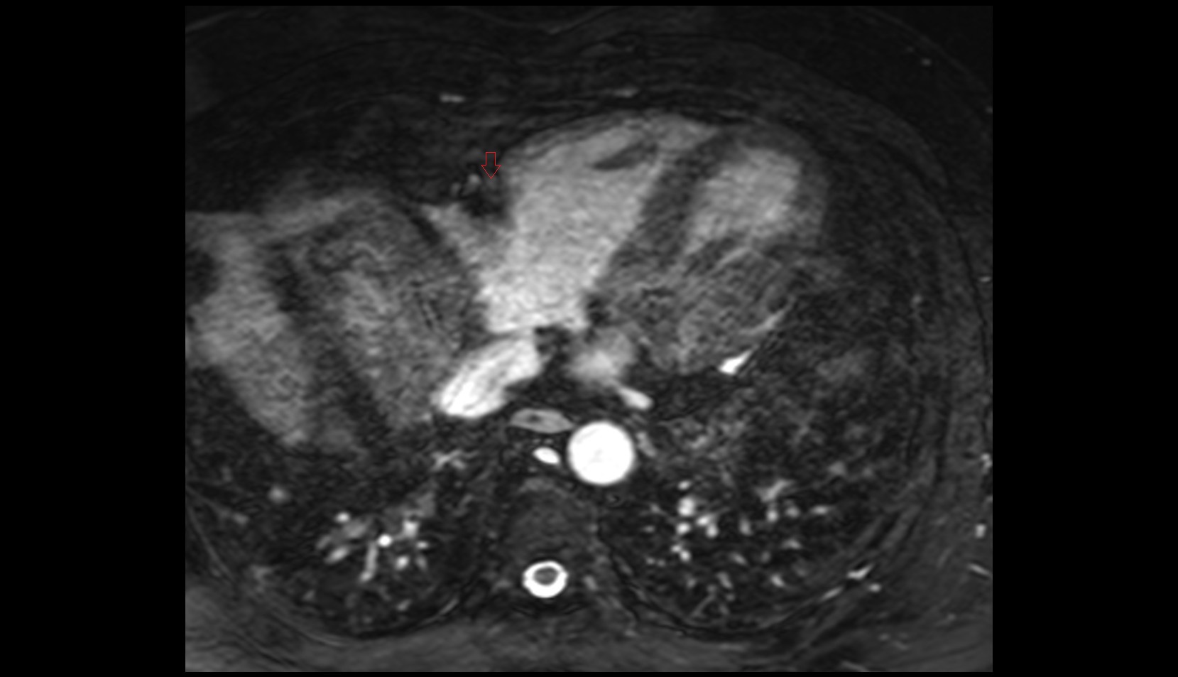 Small cardiac vein mri axial image
