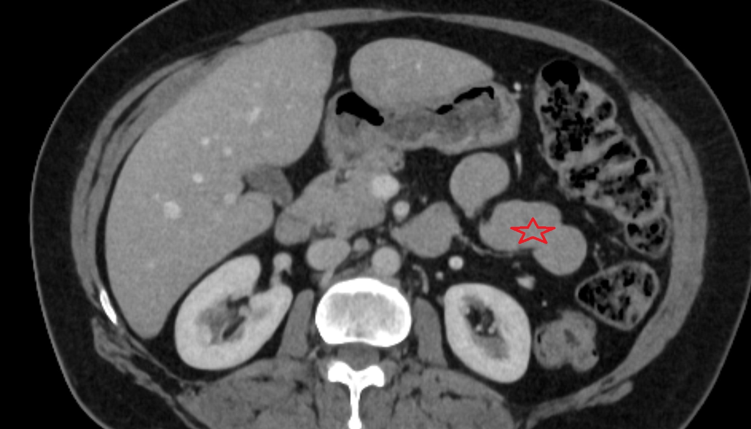 Small intestine  CT axial  anatomy  image -img-00000-00000