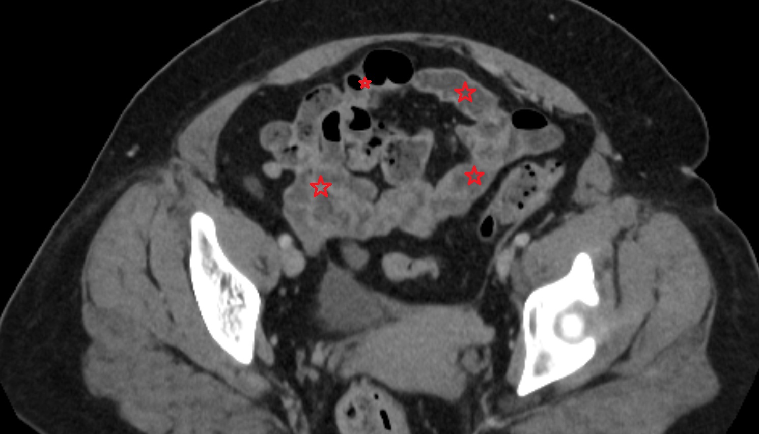 Small intestine  CT axial  anatomy  image -img-00000-00000_00001