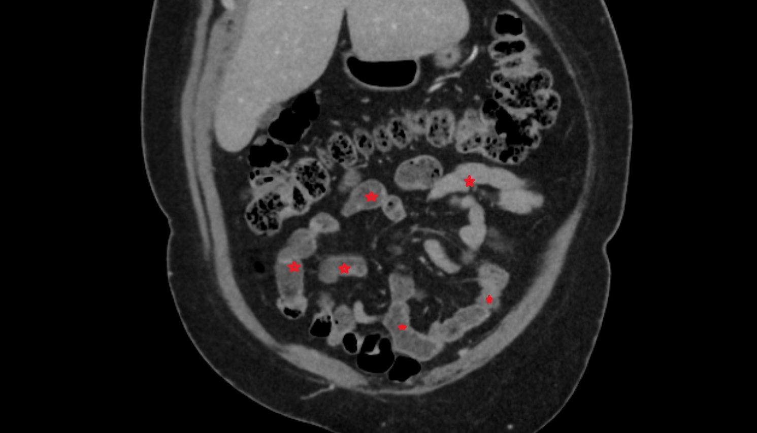 Small intestine CT coronal anatomy  image -img-00000-00000
