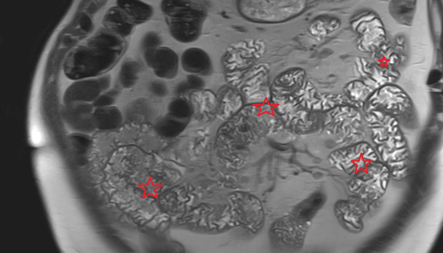 Small intestine   MRI coronal anatomy  image -img-00000-00000