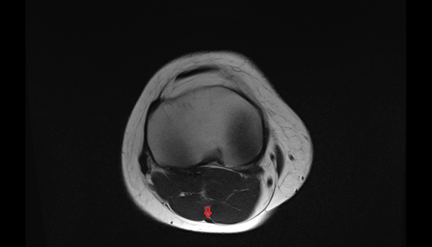 Small saphenous vein  MRI axial cross sectional anatomy 3T MRI AI enhanced  radiology  anatomy image-img-00000-00000_00001