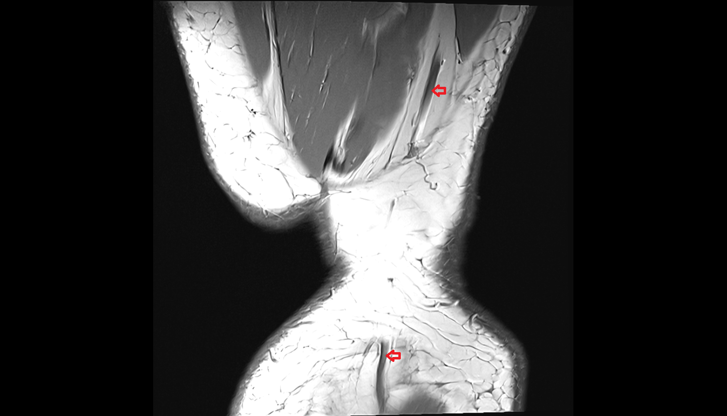 Small saphenous vein  MRI coronal  cross sectional anatomy 3T MRI AI enhanced  radiology  anatomy image-img-00000-00000