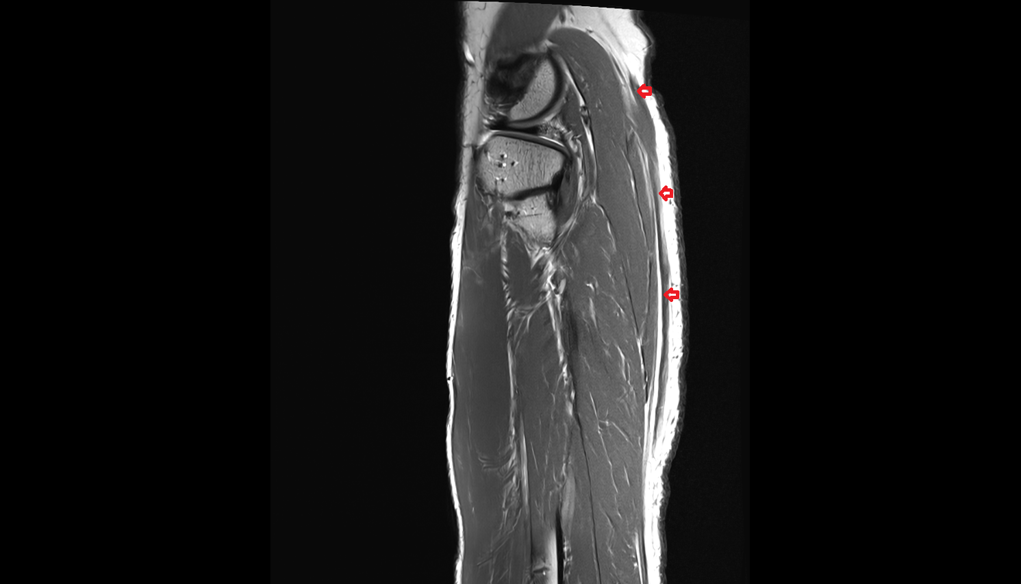 Small saphenous vein  MRI sag cross sectional anatomy 3T MRI AI enhanced  radiology  anatomy image-img-00000-00000_00001