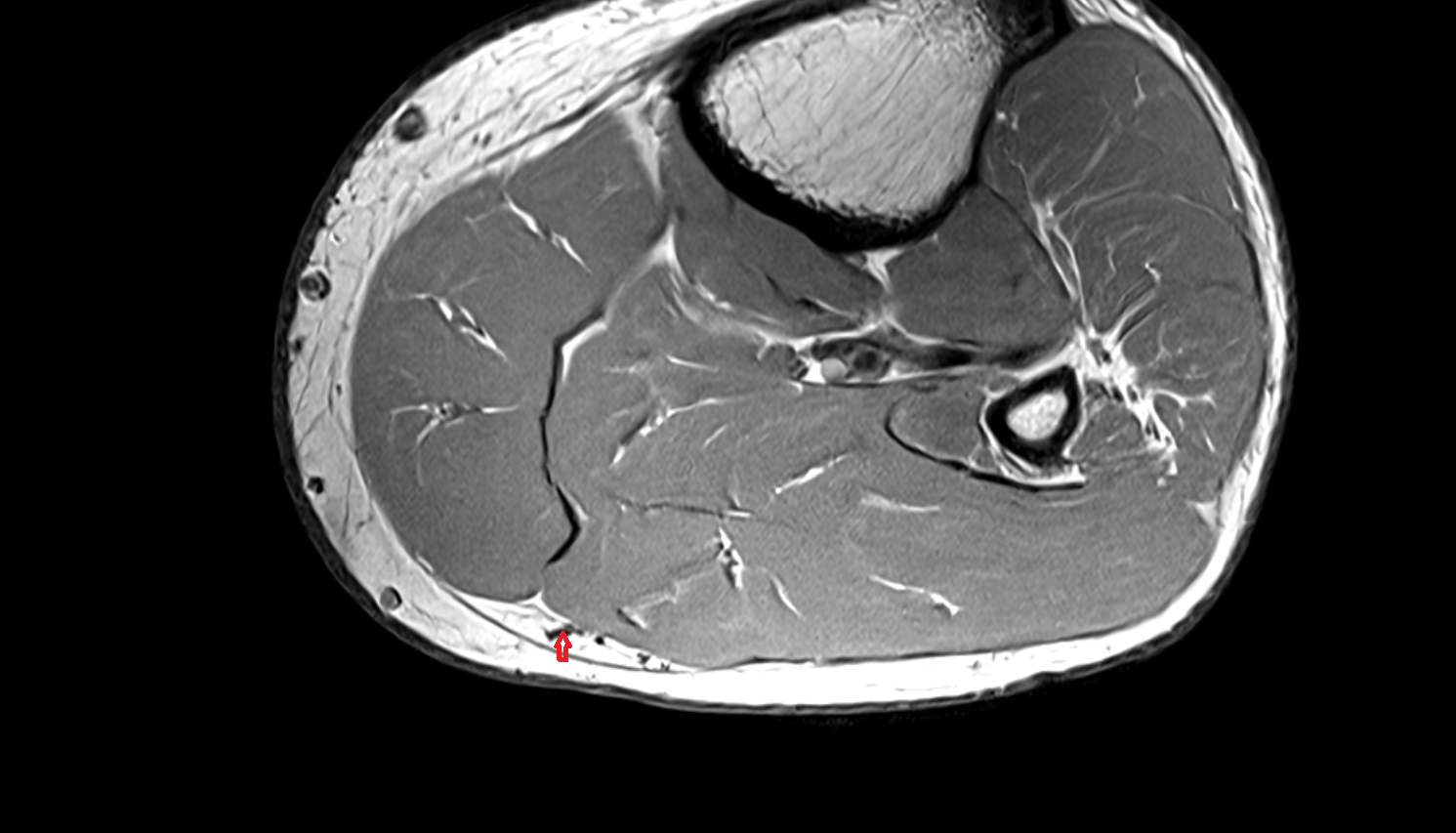 Small saphenous vein  axial  cross sectional anatomy 3T MRI AI enhanced radiology image-img-00000-00000