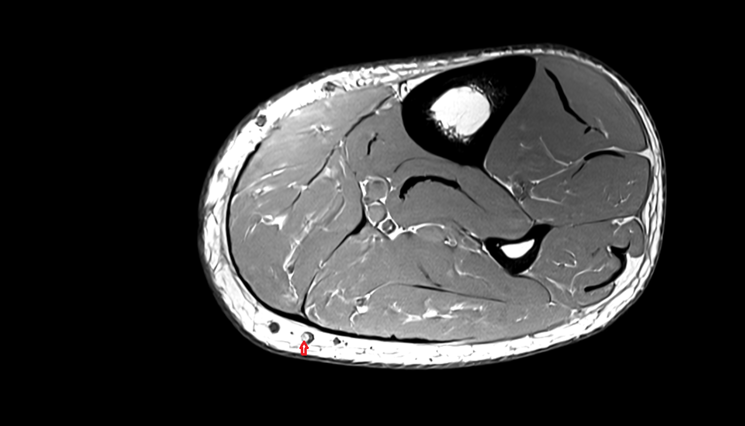 Small saphenous vein  axial  cross sectional anatomy 3T MRI AI enhanced radiology image-img-00000-00000_00001