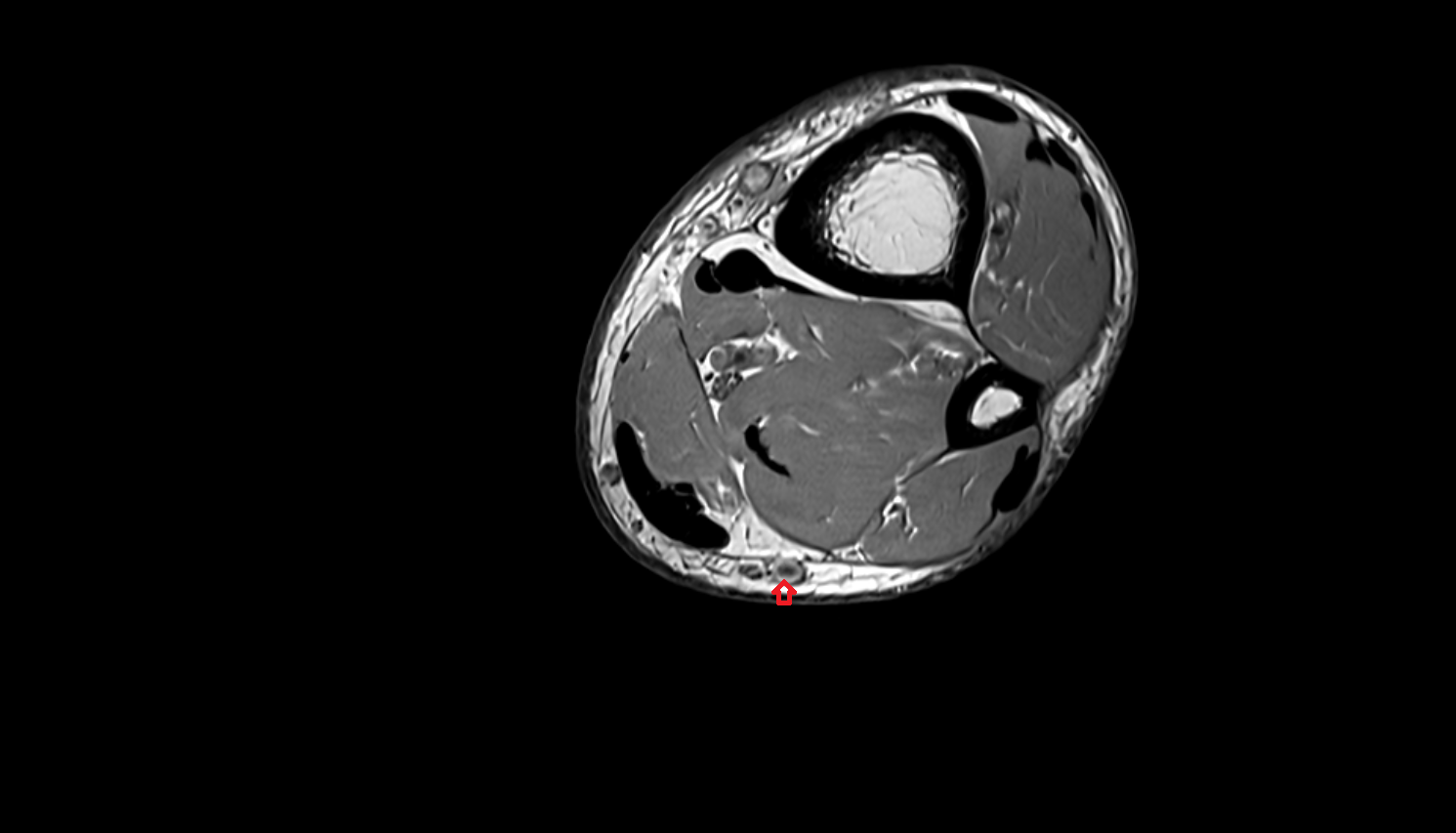 Small saphenous vein  axial  cross sectional anatomy 3T MRI AI enhanced radiology image-img-00000-00000_00002