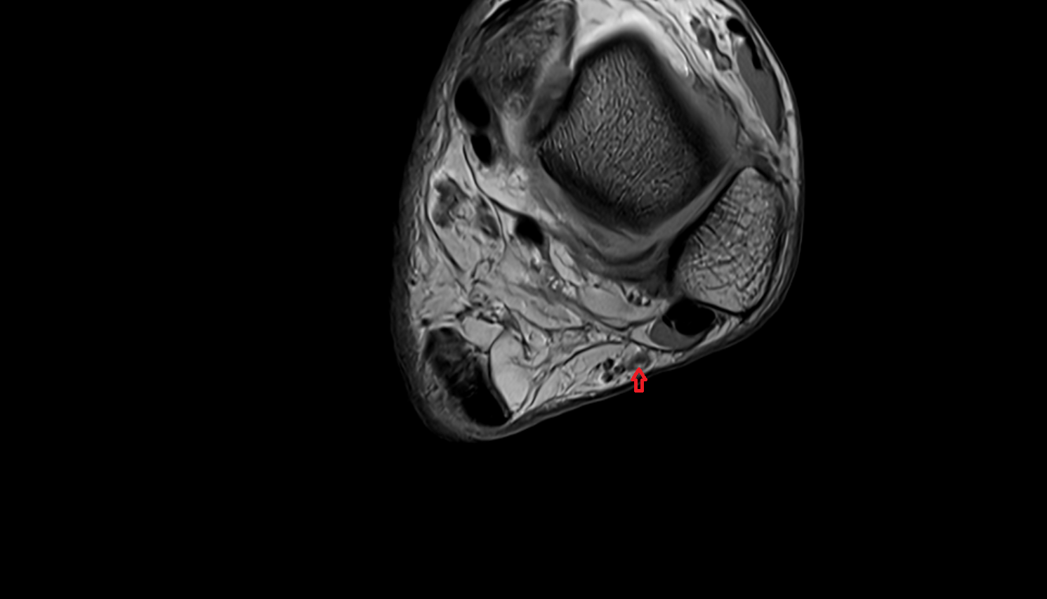Small saphenous vein  axial  cross sectional anatomy 3T MRI AI enhanced radiology image-img-00000-00000_00003