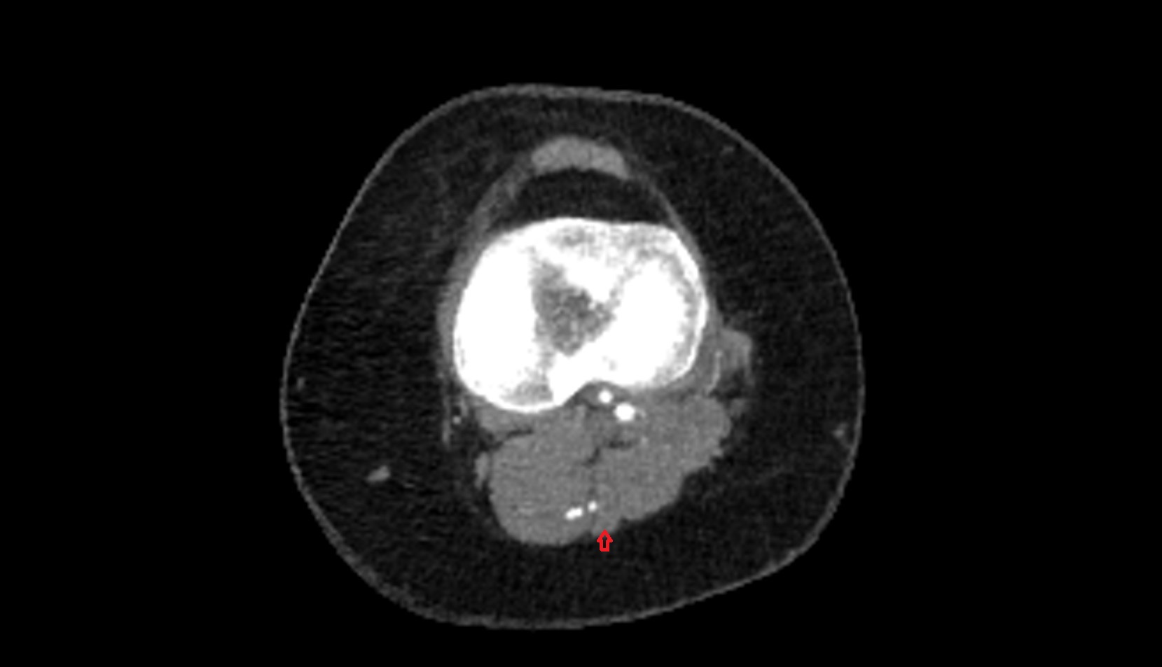 Small saphenous vein axial ct image