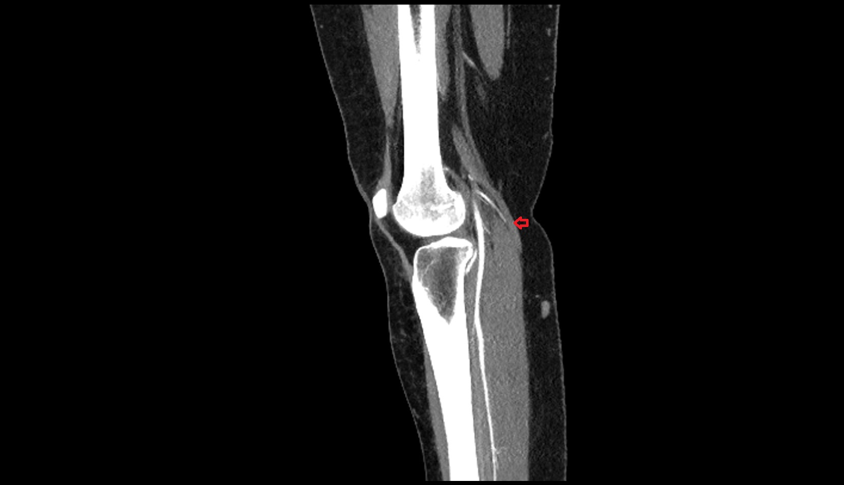Small saphenous vein ct sagittal
