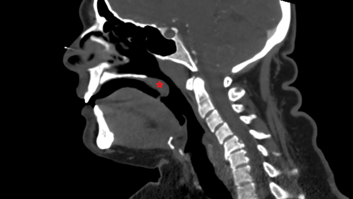 Soft palate  CT  anatomy labelled image-img-00000-00000_00001