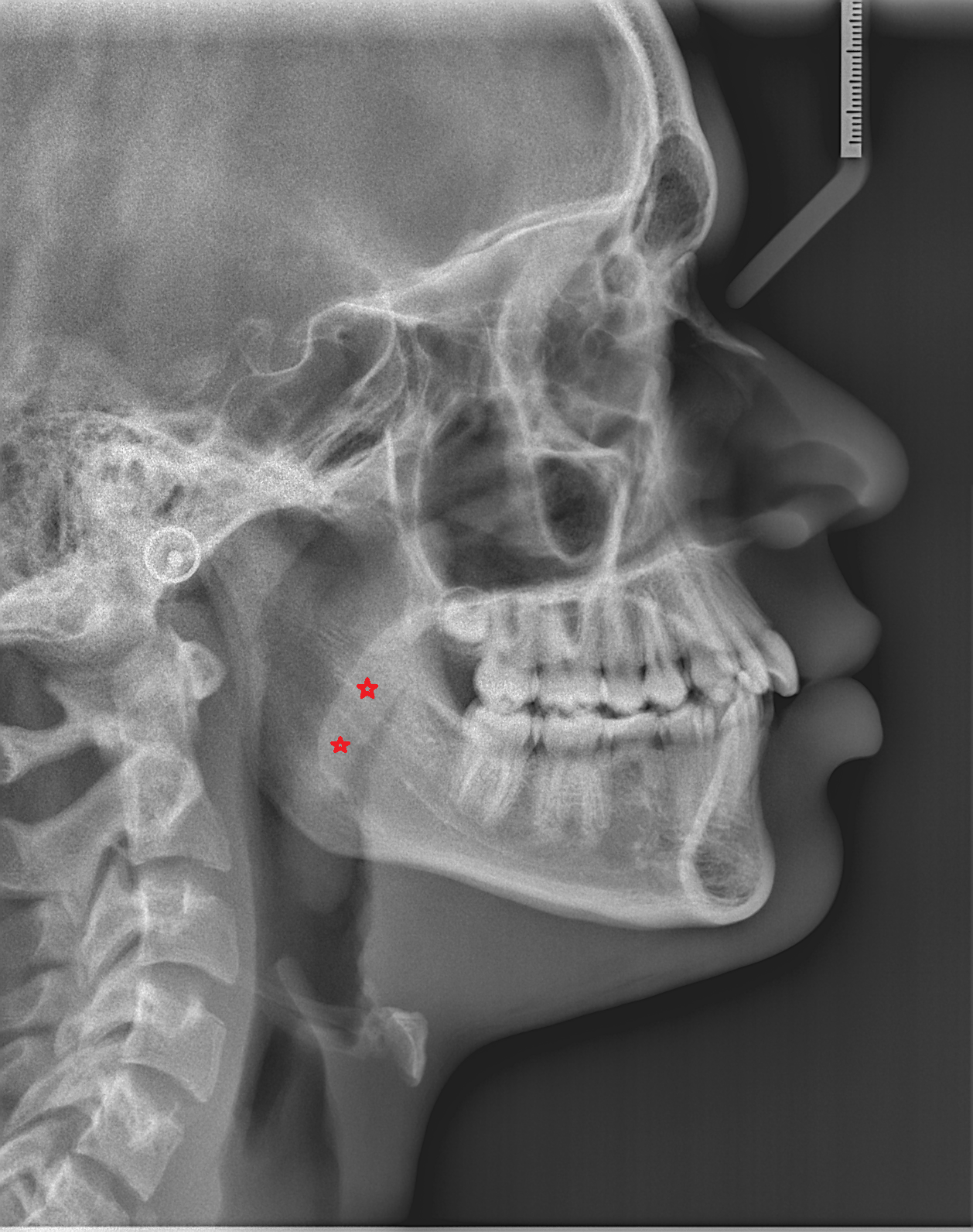 Soft palate  X RAY  anatomy labelled image-img-00000-00000