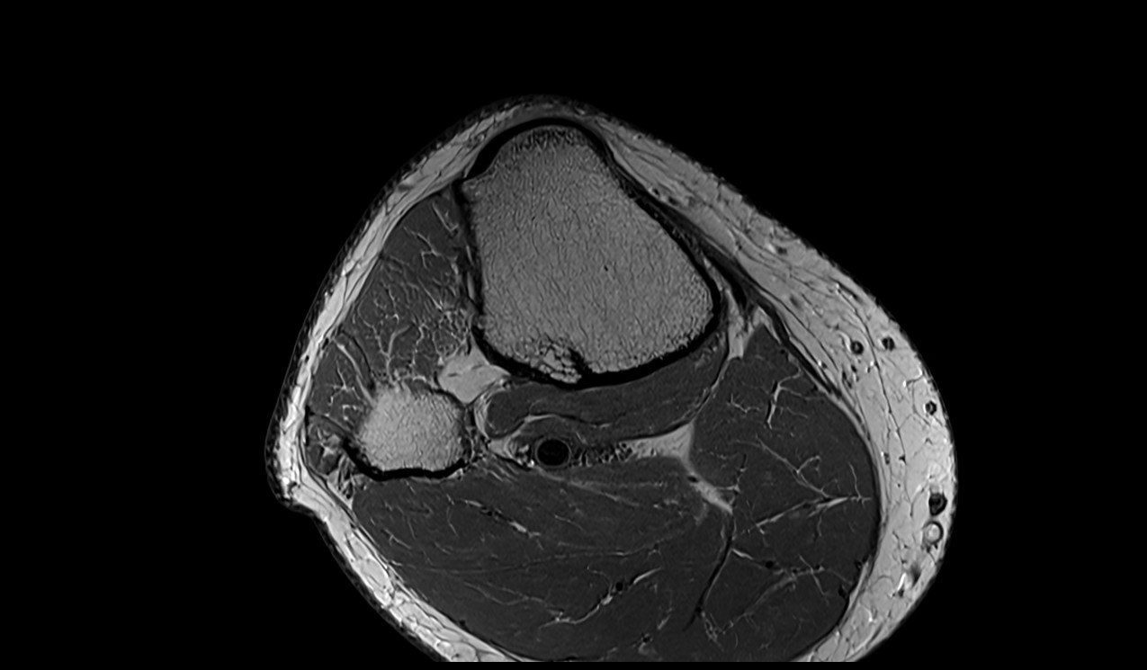 Soleus muscle anatomy image