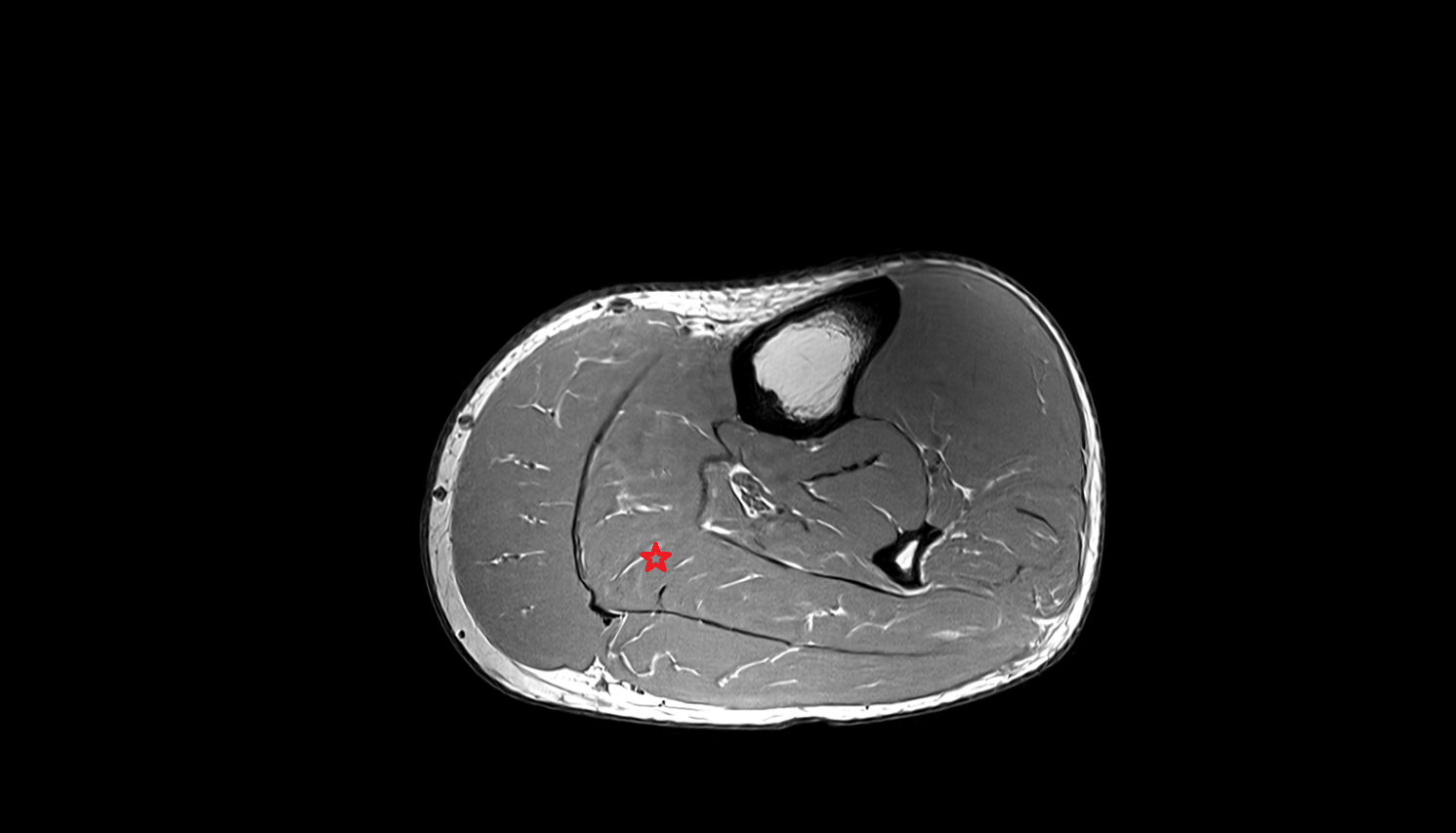 Soleus muscle axial cross sectional anatomy 3T MRI AI enhanced radiology image-img-00000-00000