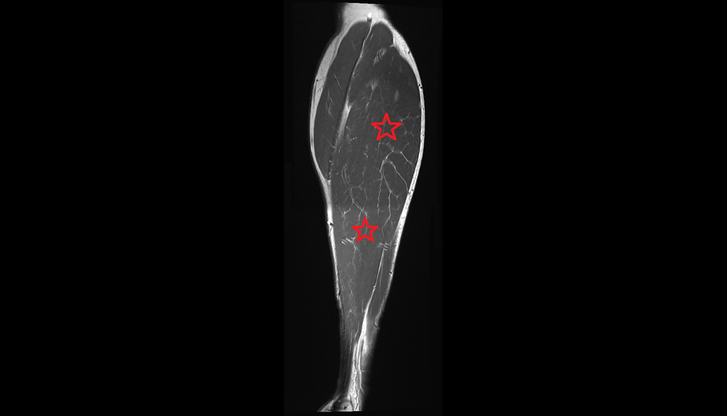 Soleus muscle coronal  cross sectional anatomy 3T radiology  anatomy image-img-00000-00000