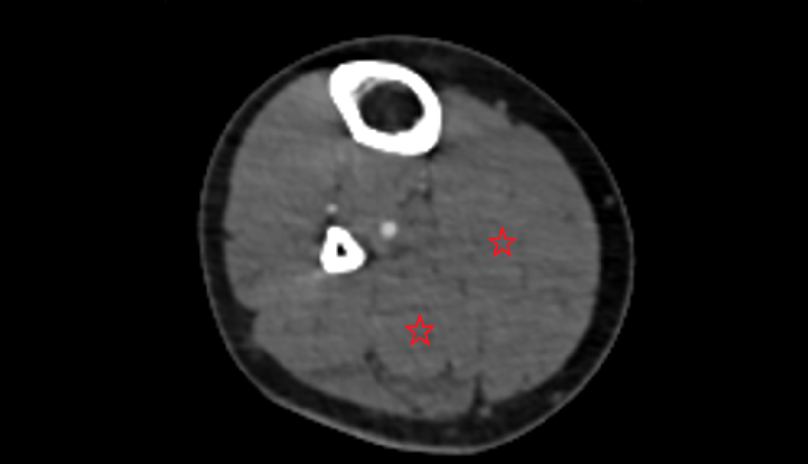 Soleus muscle ct axial image