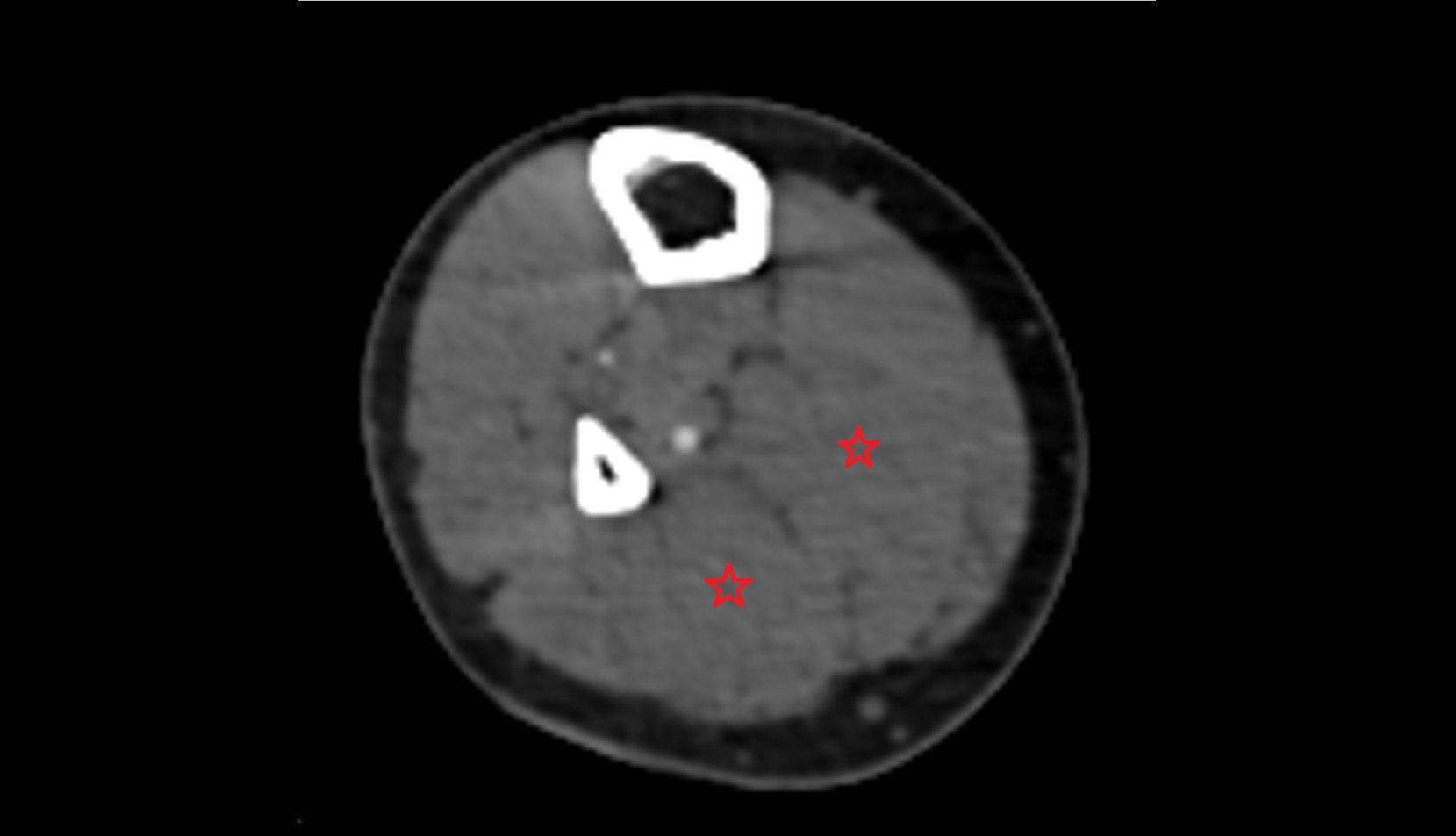 Soleus muscle ct axial image  1