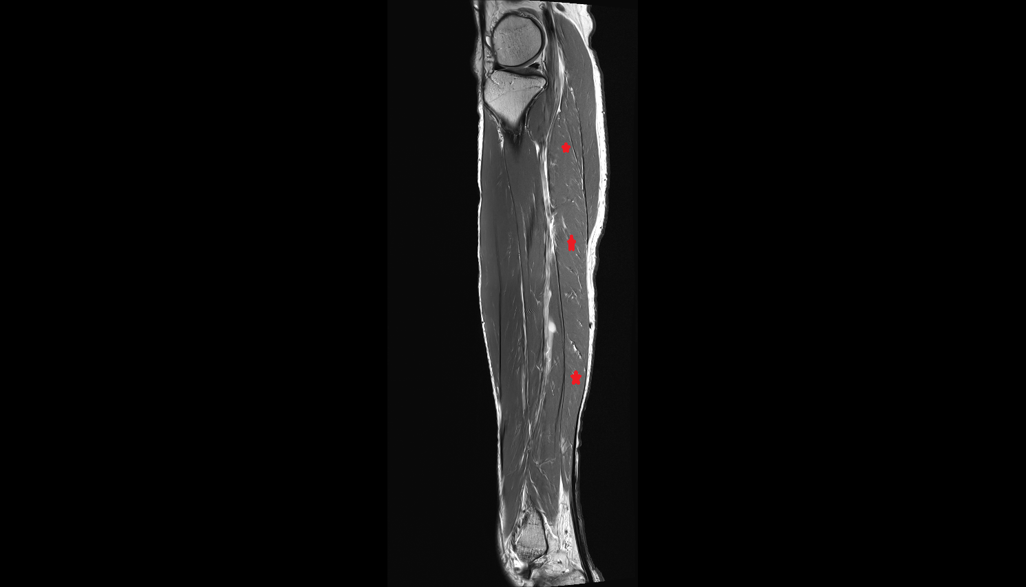 Soleus muscle sagittal  cross sectional anatomy 3T radiology  anatomy image-img-00000-00000